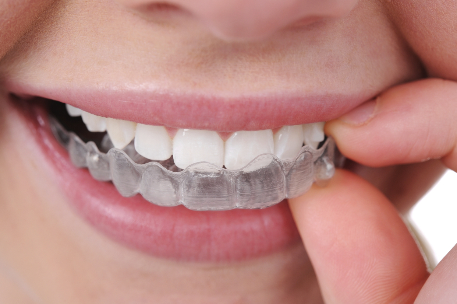 Orthodontics / Braces